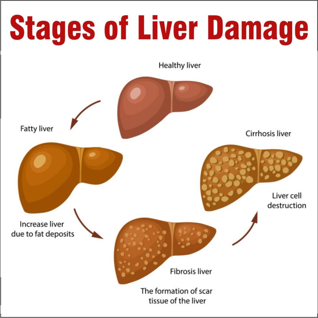 liver-cirrhosis